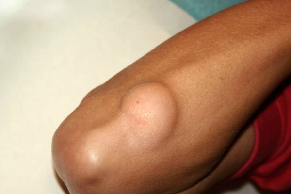 Lipoma Excision Treatment