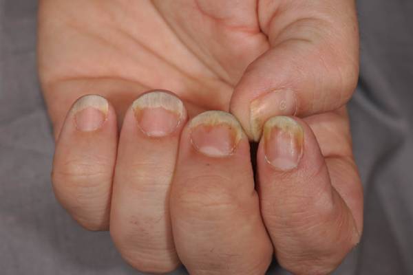 Nail Disease Treatment