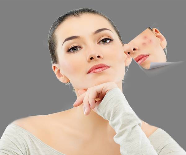 melasma dark spots