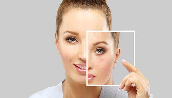 acne2