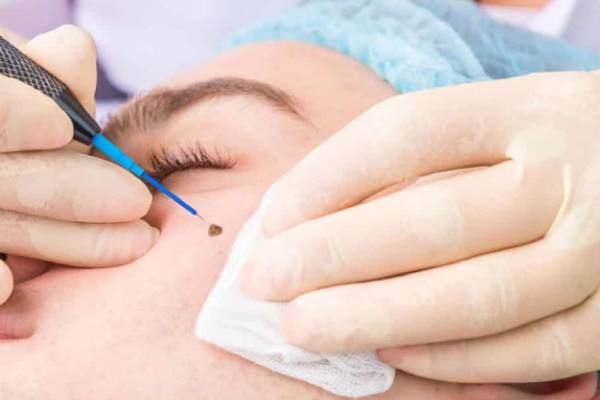electrosurgery