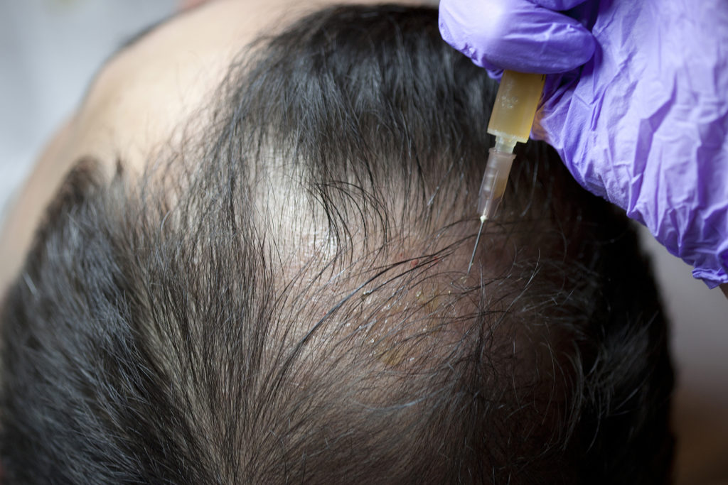PRP Hair Treatment - Total Skin Pro Clinic